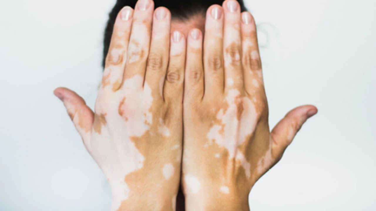 Vitiligo (শ্বেতী/ধবল রোগ) দূর করার হোমিওপ্যাথিক ঔষধসমূহ